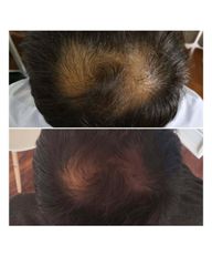 Plasma Capilar - Medvital