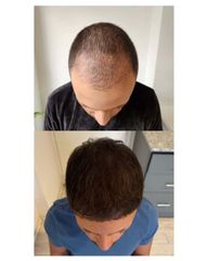 Plasma Capilar - Medvital