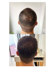 Plasma Capilar - Medvital