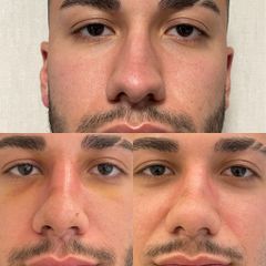 Rinoplastia