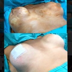 Recambio de prótesis- Contractura capsular