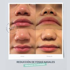 Rinoplastia - Dr. Hugo Ayarde