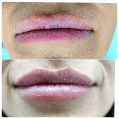 Relleno de labios - Dr. Néstor Arredes
