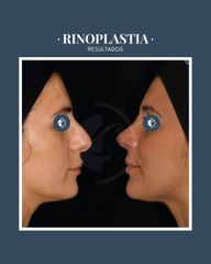 Rinoplastia - Dr. Federico Coccaro