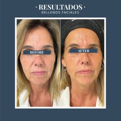 Rellenos faciales - Dr. Federico Coccaro