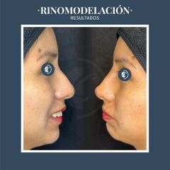 Rinomodelación  - Dr. Federico Coccaro