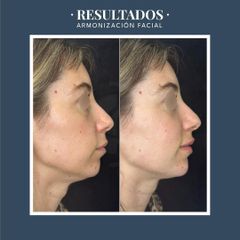 Rellenos faciales - Dr. Federico Coccaro