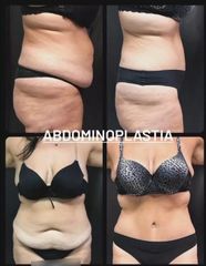 Abdominoplastia - Sergio Eduardo Jose