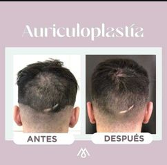 Auriculoplastia