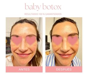 Botox - Dra. Jimena D. Frasso