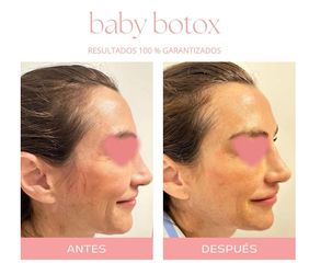 Botox - Dra. Jimena D. Frasso