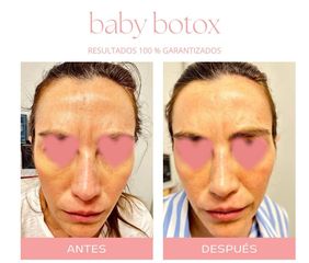 Botox - Dra. Jimena D. Frasso