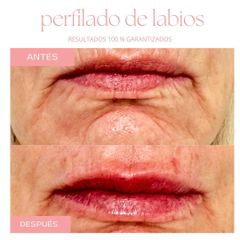 Relleno de labios - Dra. Jimena D. Frasso