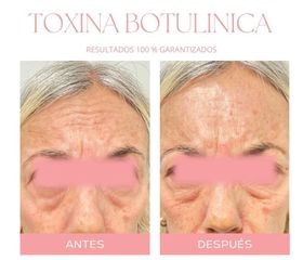 Botox - Dra. Jimena Frasso