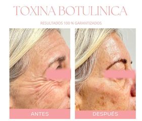 Botox - Dra. Jimena Frasso