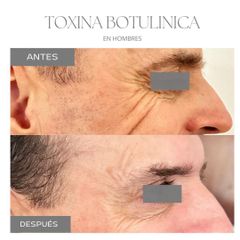 Botox - Dra. Jimena Frasso