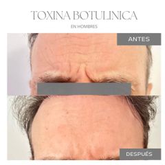 Botox - Dra. Jimena Frasso