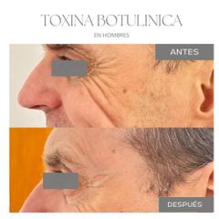 Botox - Dra. Jimena Frasso