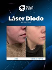 Láser Diodo en rostro - Dra. Jimena Frasso