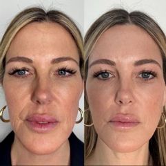 Rejuvenenecimiento Facial - Dra. Jimena D. Frasso