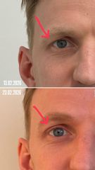 Blefaroplastia sin cirugía - Dra. Jimena D. Frasso