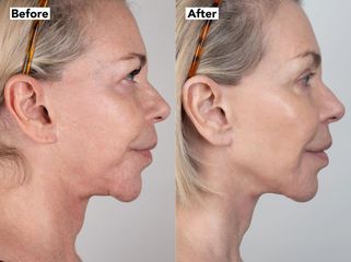 Rejuvenecimiento Facial - Dra. Jimena D. Frasso