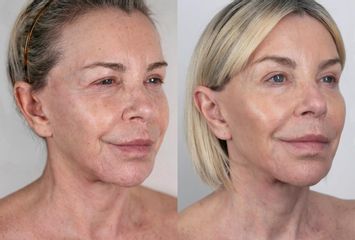Rejuvenecimiento Facial - Dra. Jimena D. Frasso