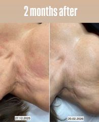 Rejuvenecimiento de Cuello - Dra. Jimena D. Frasso