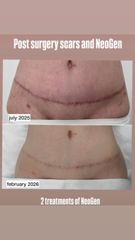 Eliminar cicatrices  - Dra. Jimena D. Frasso