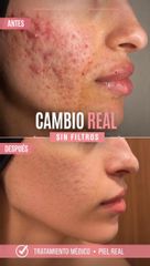 Cicatrices Acne - Dra. Jimena D. Frasso