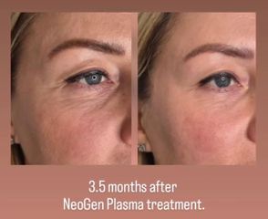 NeoGen Plasma treatment