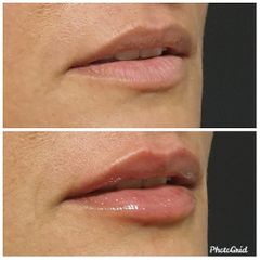 Relleno de labios