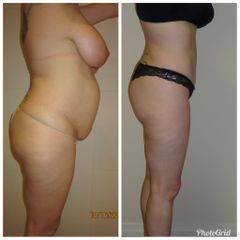 Abdominoplastia + Liposuccion