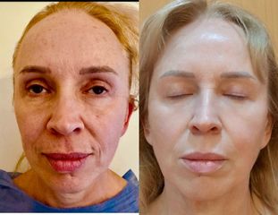 Rejuvenenecimiento Facial con Endolift - Dr. Diego Cunille