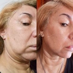 Endolift Cara y Cuello - Dr. Diego Cunille