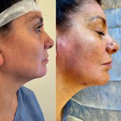 Endolift - Dr. Diego Cunille