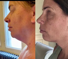 Endolift - Dr. Diego Cunille