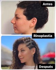 Rinoplastia - Dra. María de la Paz Vélez