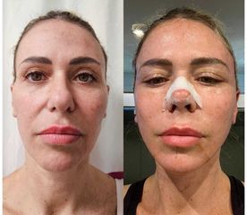 Lifting Facial - Dr. Matias Llabres