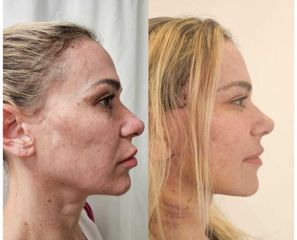 Lifting Facial - Dr. Matias Llabres