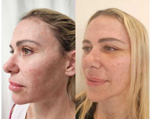 Lifting Facial - Dr. Matias Llabres