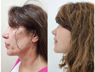 Lifting Facial - Dr. Matias Llabres