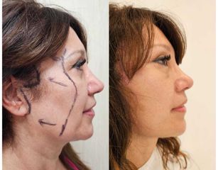 Lifting Facial - Dr. Matias Llabres