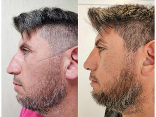 Rinoplastia - Dr. Matias Llabres