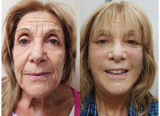 Lifting - Dr. Matias Llabres
