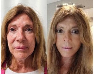 Lifting Facial - Dr.Matias Llabres