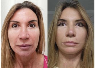 Lifting Facial - Dr.Matias Llabres