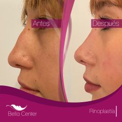 Rinoplastia - Bella Center 