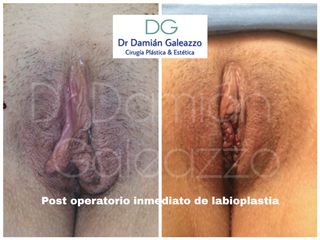 Labioplastia post operatorio inmediato