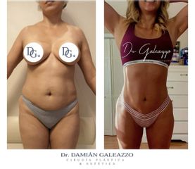 Liposucción - Dr. Damián Galeazzo